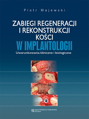 Zabiegi regeneracji i rekonstrukcji kości w implantologii