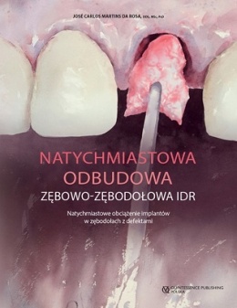 Natychmiastowa odbudowa zębowo-zębodołowa IDR